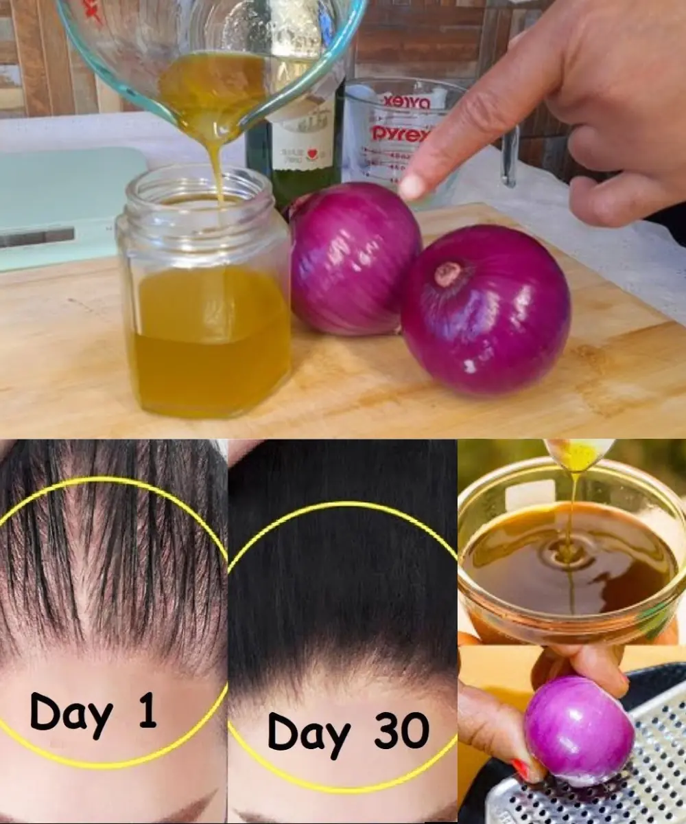 How to Make Onion Hair Oil for Faster Hair Growth and to Stop Hair Fall