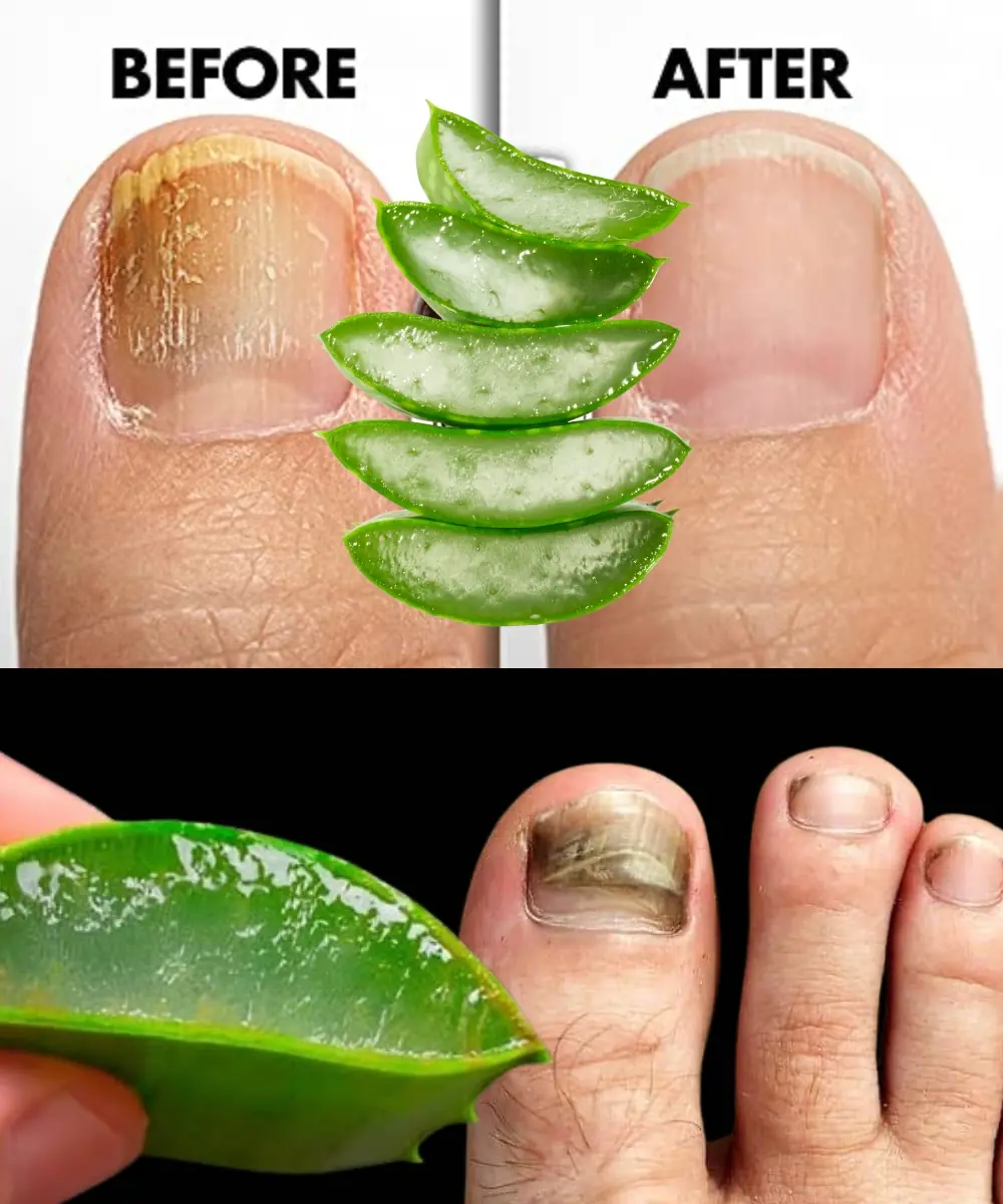 Kills Nail Fungus Instantly! The Best Aloe Vera Remedy