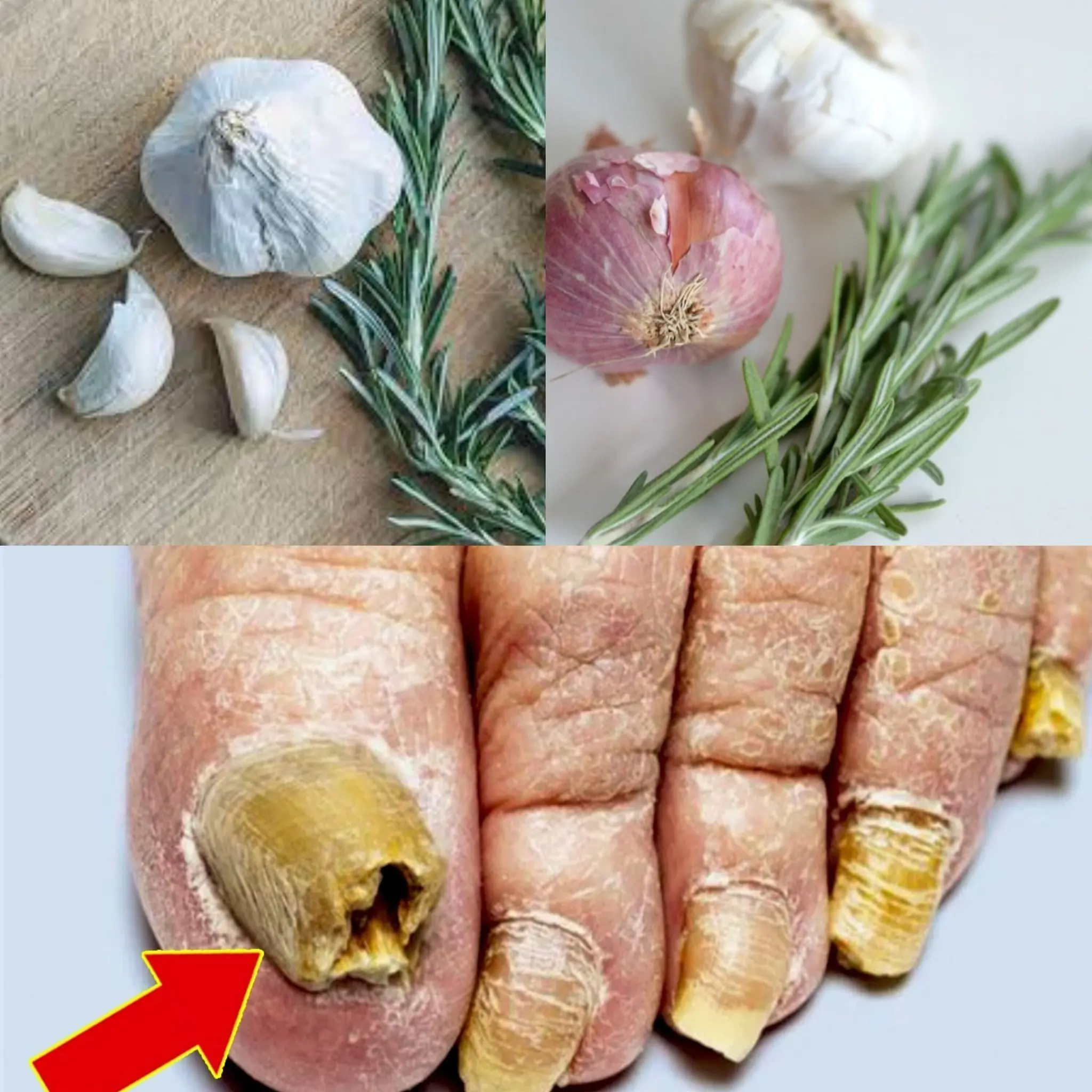 Natural Nail Fungus Treatment with Garlic and Rosemary